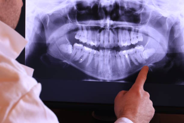 Best Emergency Tooth Extraction in Butler, IN